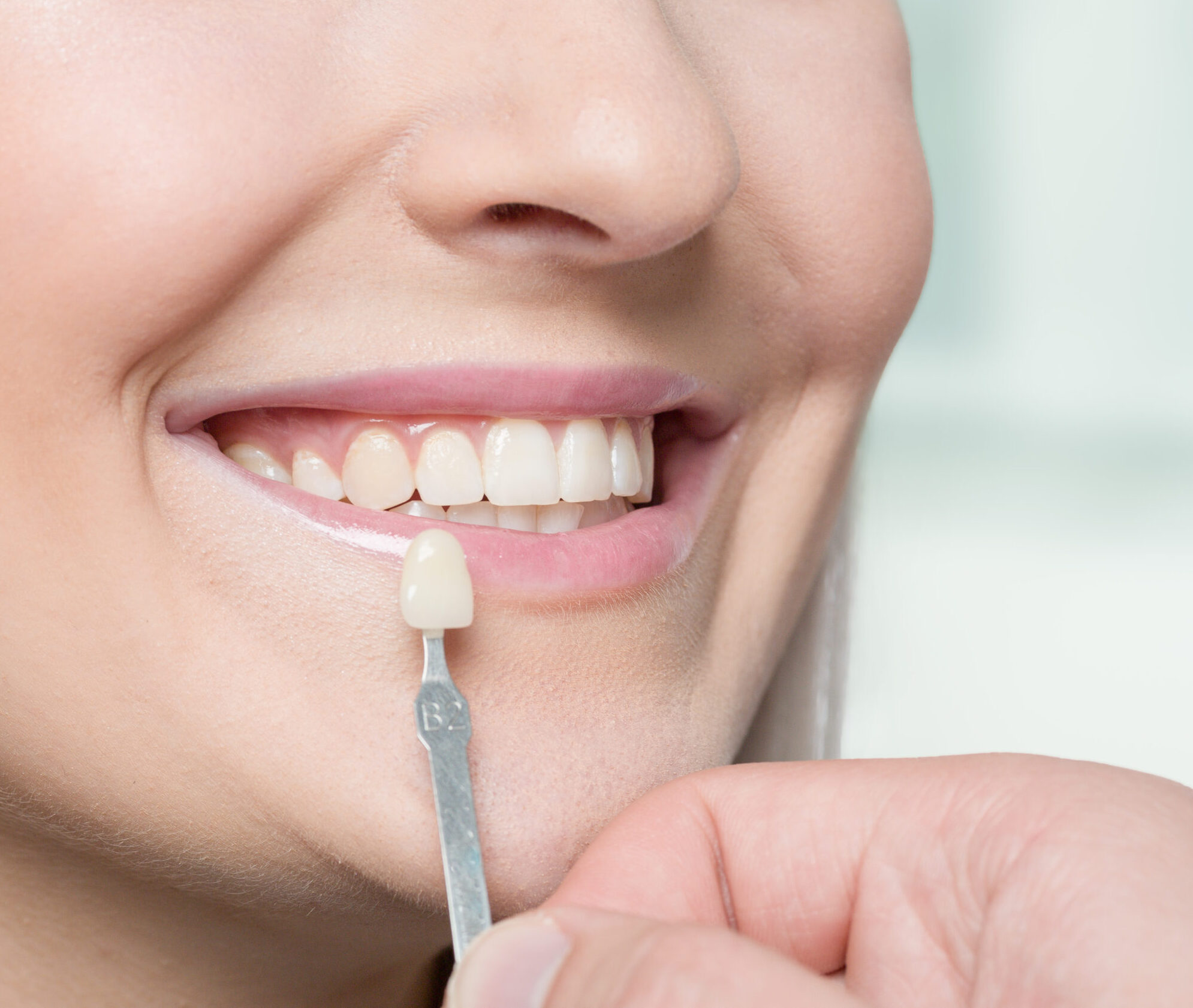 Tanden bleken - Clinics : BBO Clinics